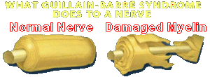 Click to GuillainBarr syndrome