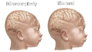 Click to Zika and microcephaly